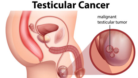 10-warning-signs-of-testicular-cancer