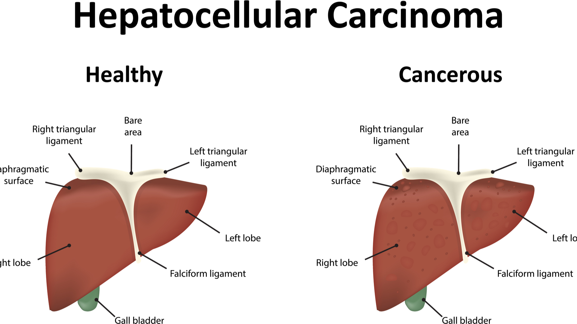 6-things-you-should-know-about-liver-cancer
