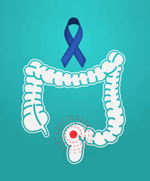 colon-cancer-treatment-in-gurgaon