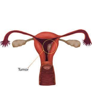endometrial-cancer-treatment-in-gurgaon