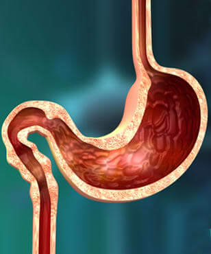 stomach-cancer-treatment-in-gurgaon