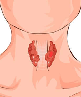 thyroid-cancer-treatment-in-gurgaon